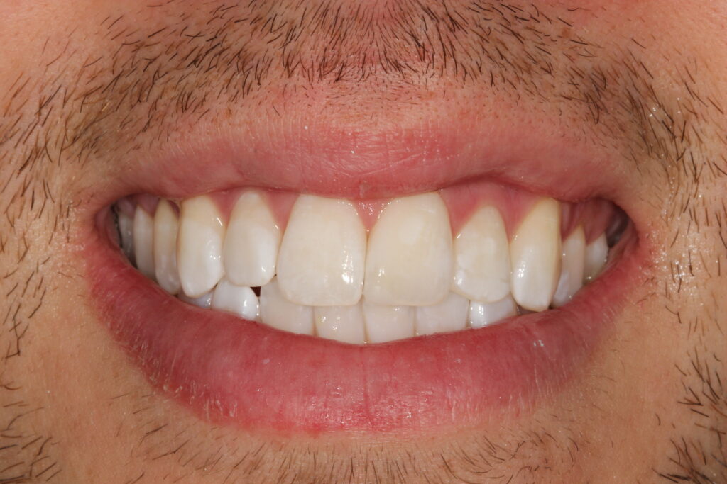 After teeth whitening