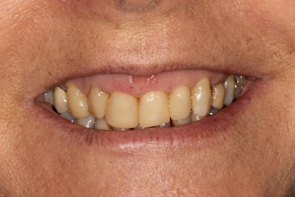 after veneers