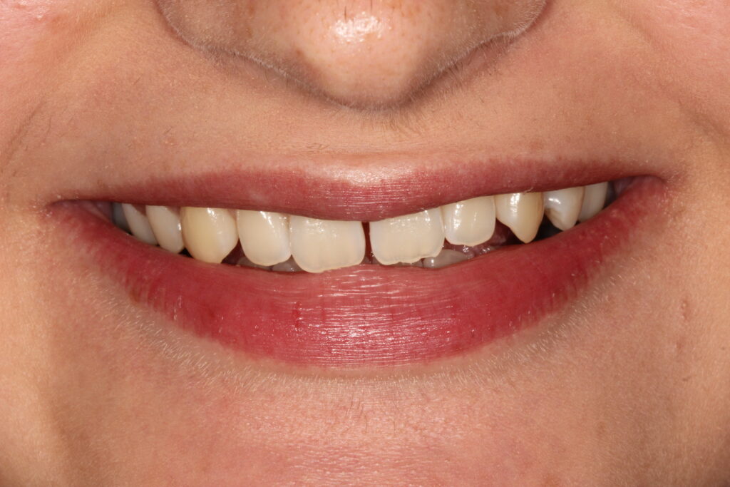 before composite bonding