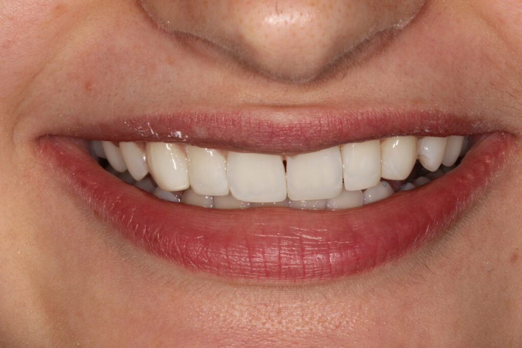 after composite bonding