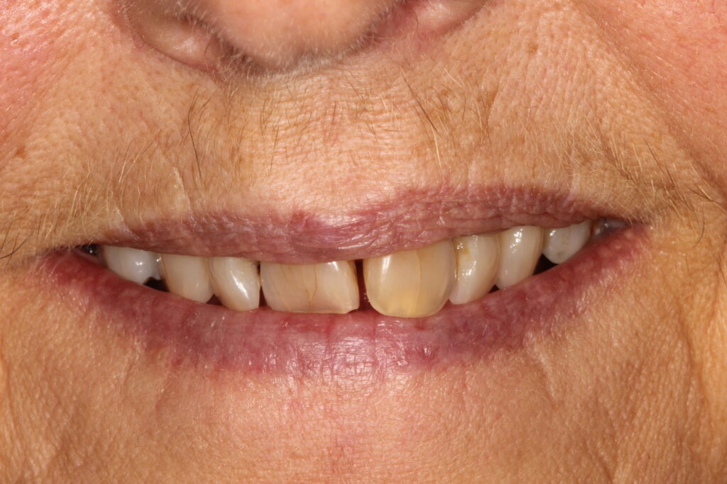 Before teeth whitening