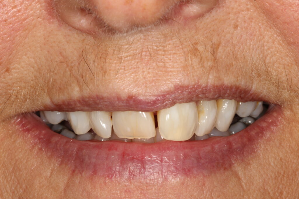 After teeth whitening