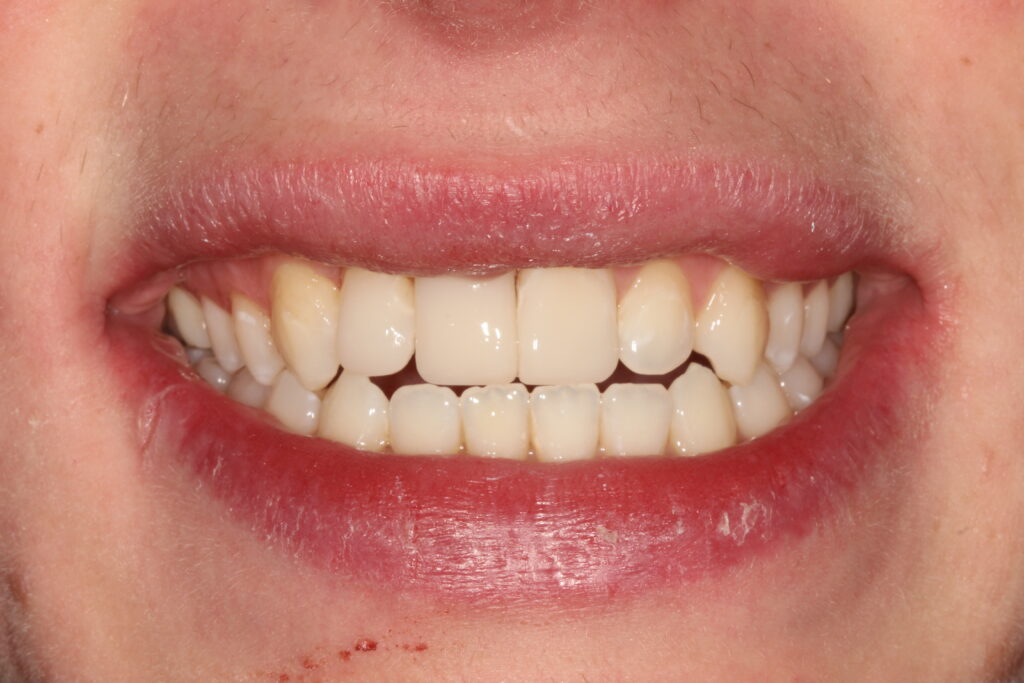 after composite bonding