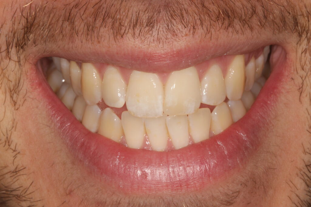 before teeth whitening