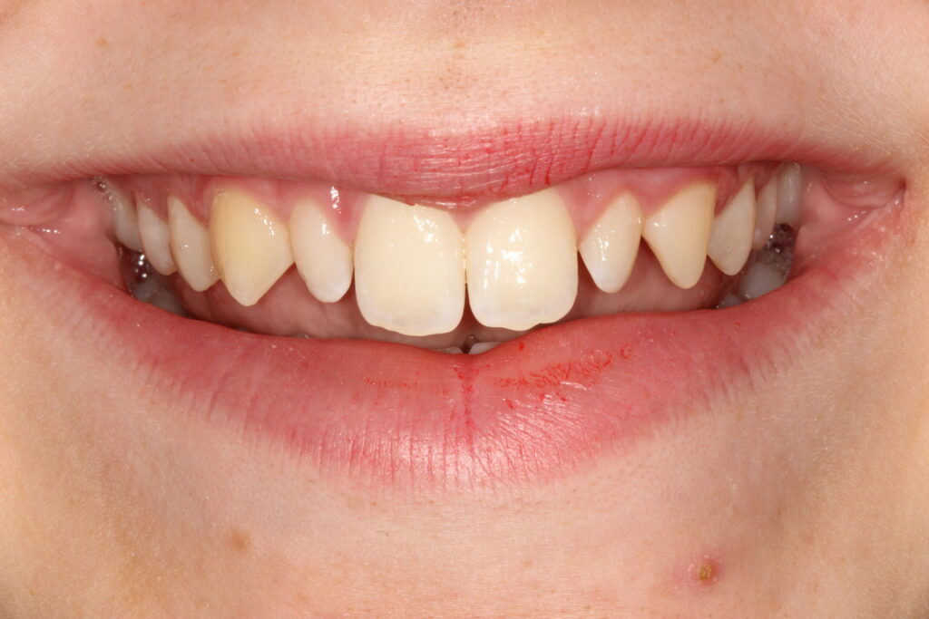 before smile makeover