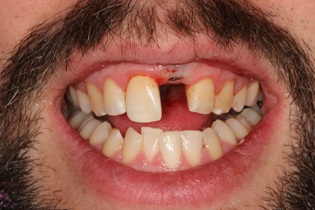 Before single tooth implant