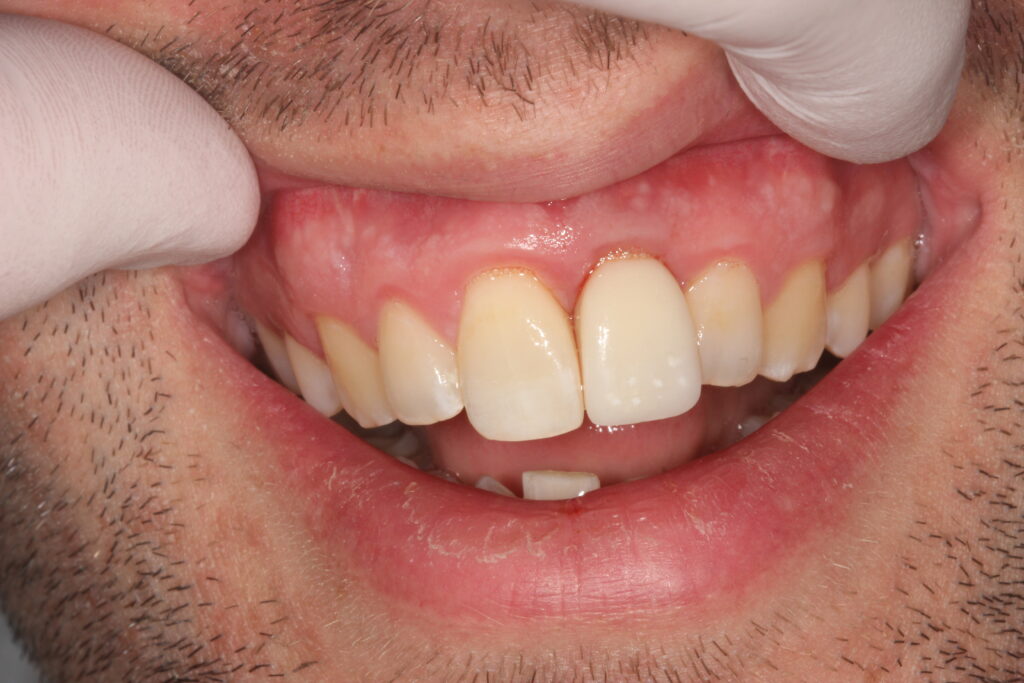 after single tooth implants