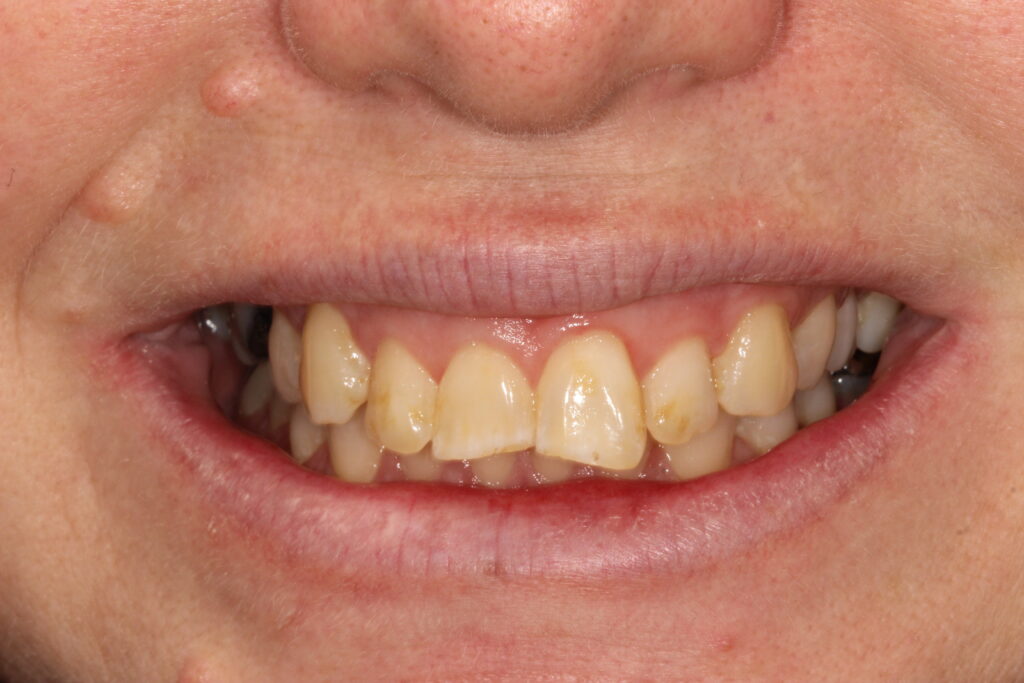 before smile makeover