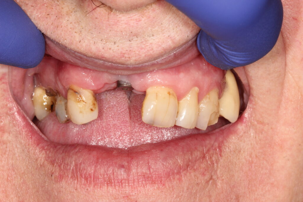 before single tooth implant