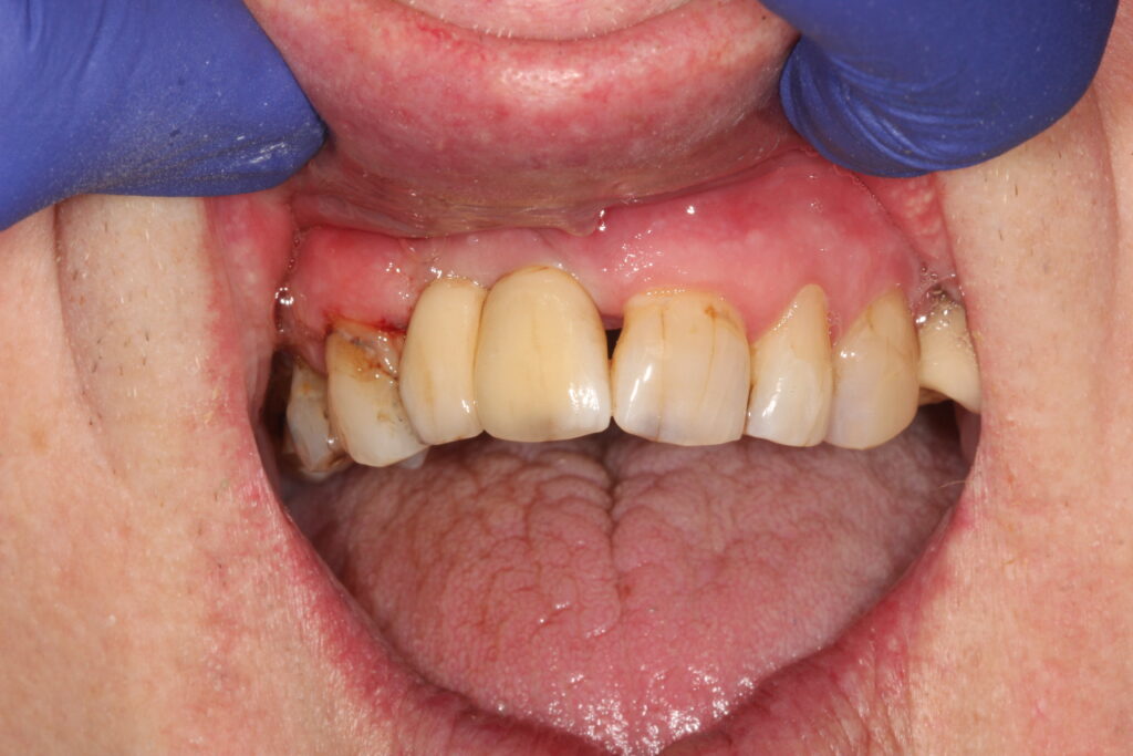 after single tooth implant