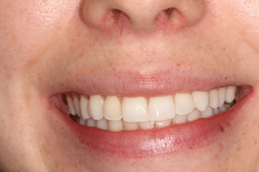 after smile makeover