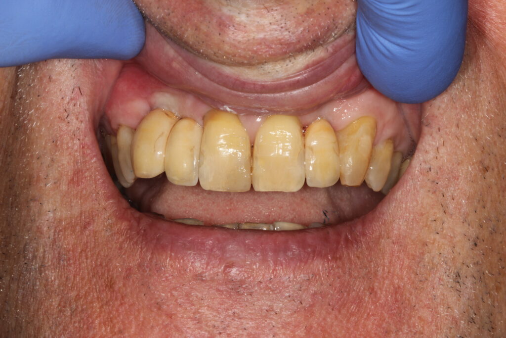 after dental implants