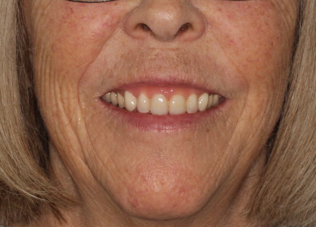after implant dentures