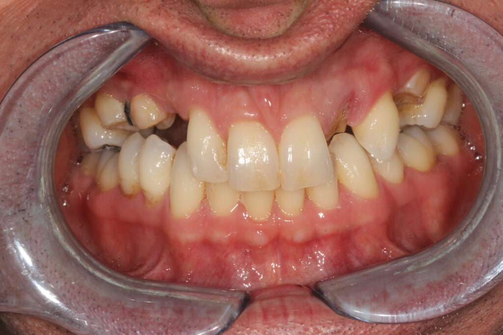 before dental implants