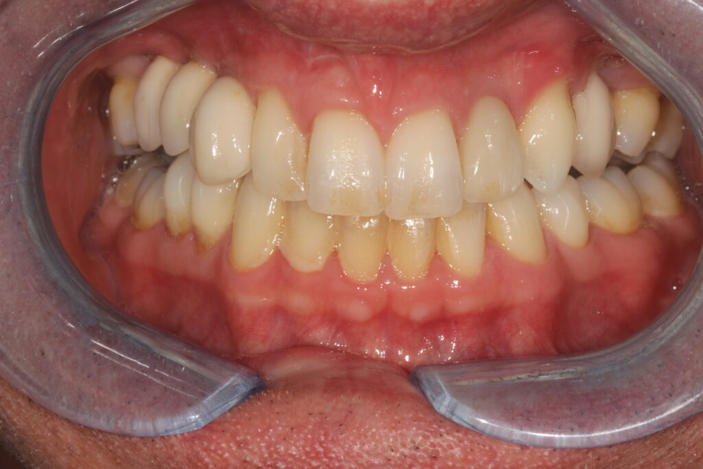 after dental implants
